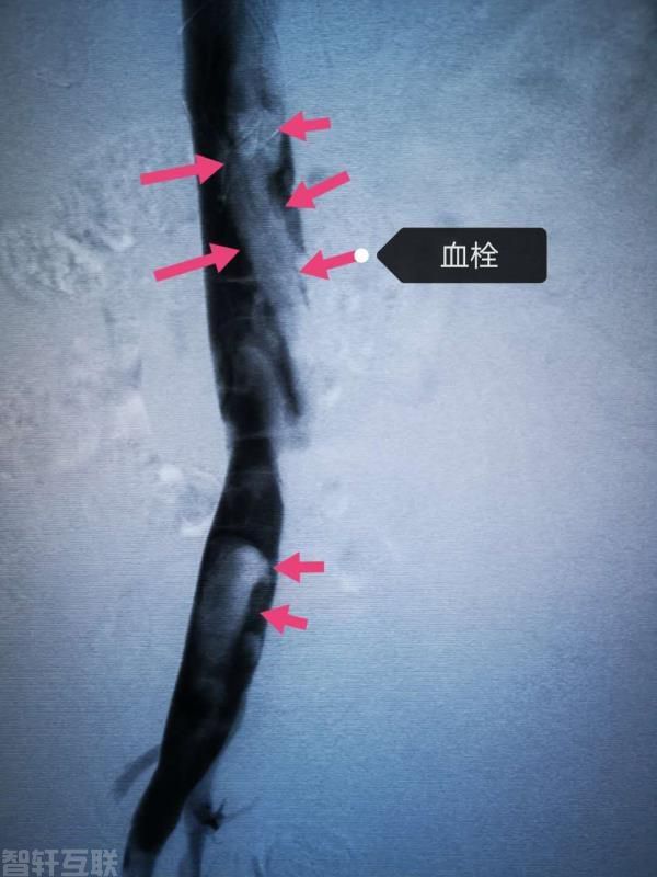  图说：李茂全团队在取栓(图2)