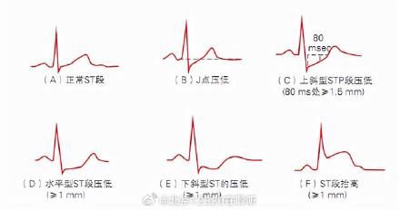  为什么其他疾病患者也需要做心电图检查？(图1)