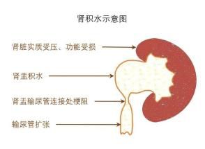  儿童肾积水的治疗及利尿剂介入肾动态显像(图2)