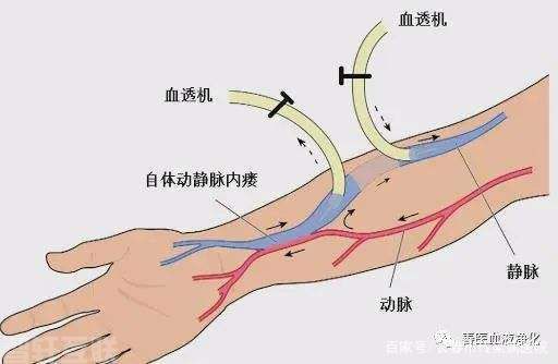  血液透析管理系统的重要性及护理要点(图3)